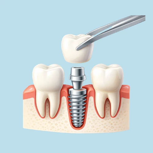 ทันตกรรมรากเทียม